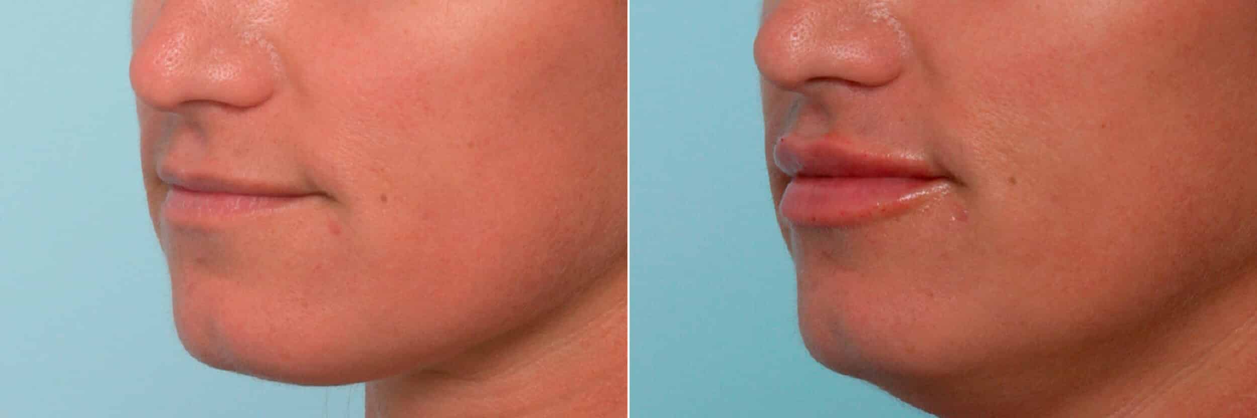 Before and After Image: Lip Enhancement Before and After Photos in Houston, TX, Patient 11384 - left-front-oblique