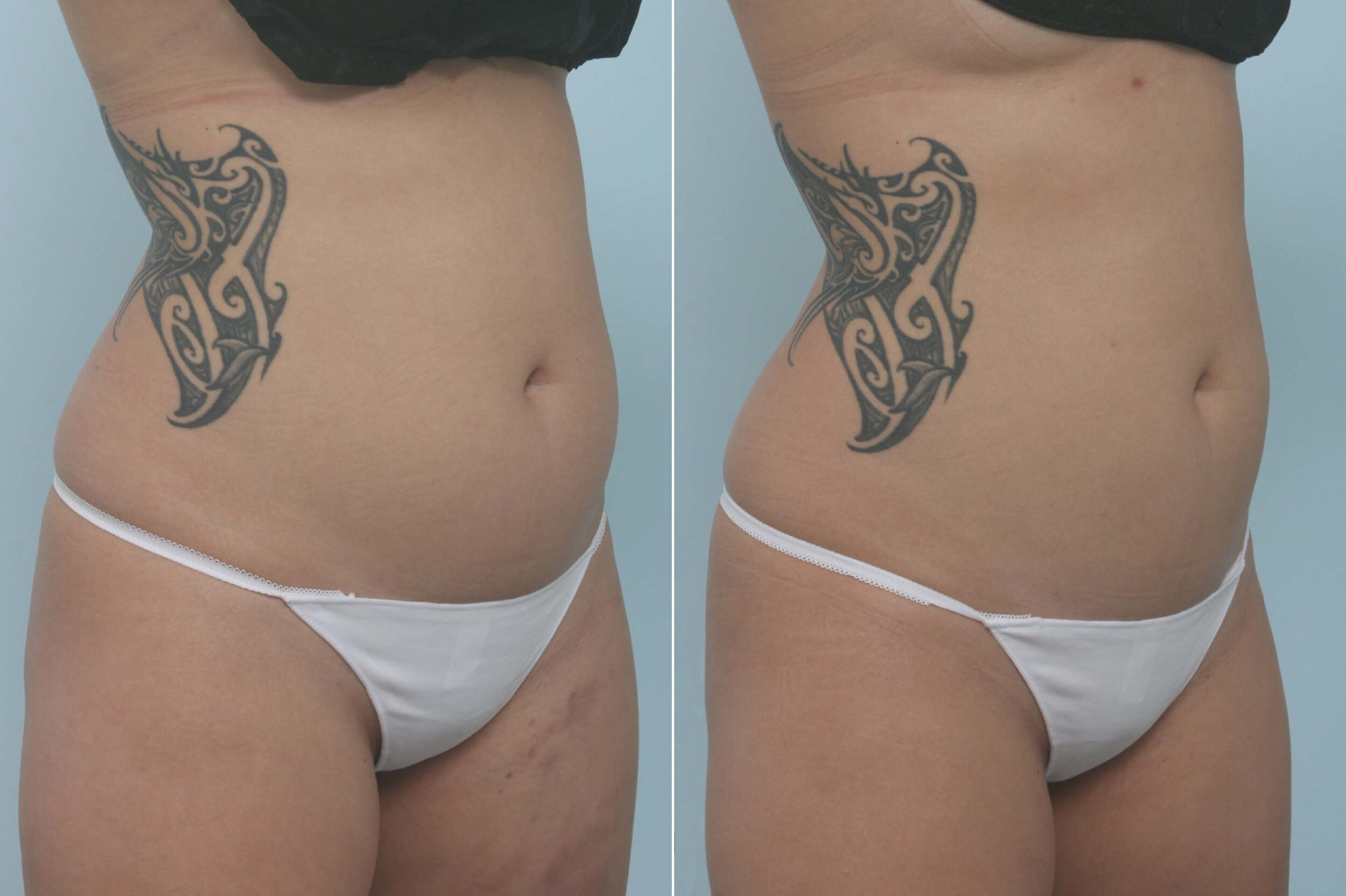 Before and After Image: CoolSculpting Before and After Photos in Houston, TX, Patient 11717 - right-front-oblique
