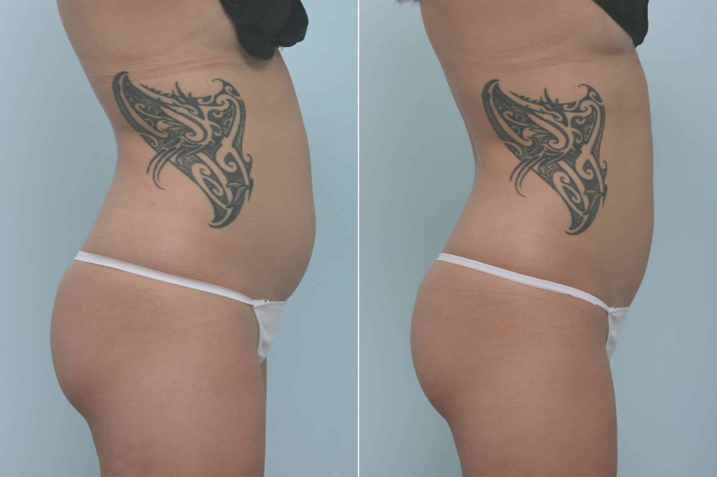 Before and After Image: CoolSculpting Before and After Photos in Houston, TX, Patient 11717 - right-side