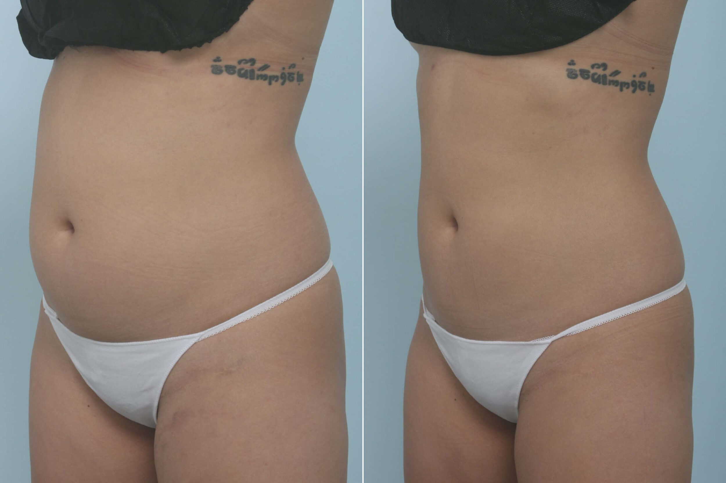 Before and After Image: CoolSculpting Before and After Photos in Houston, TX, Patient 11717 - left-front-oblique