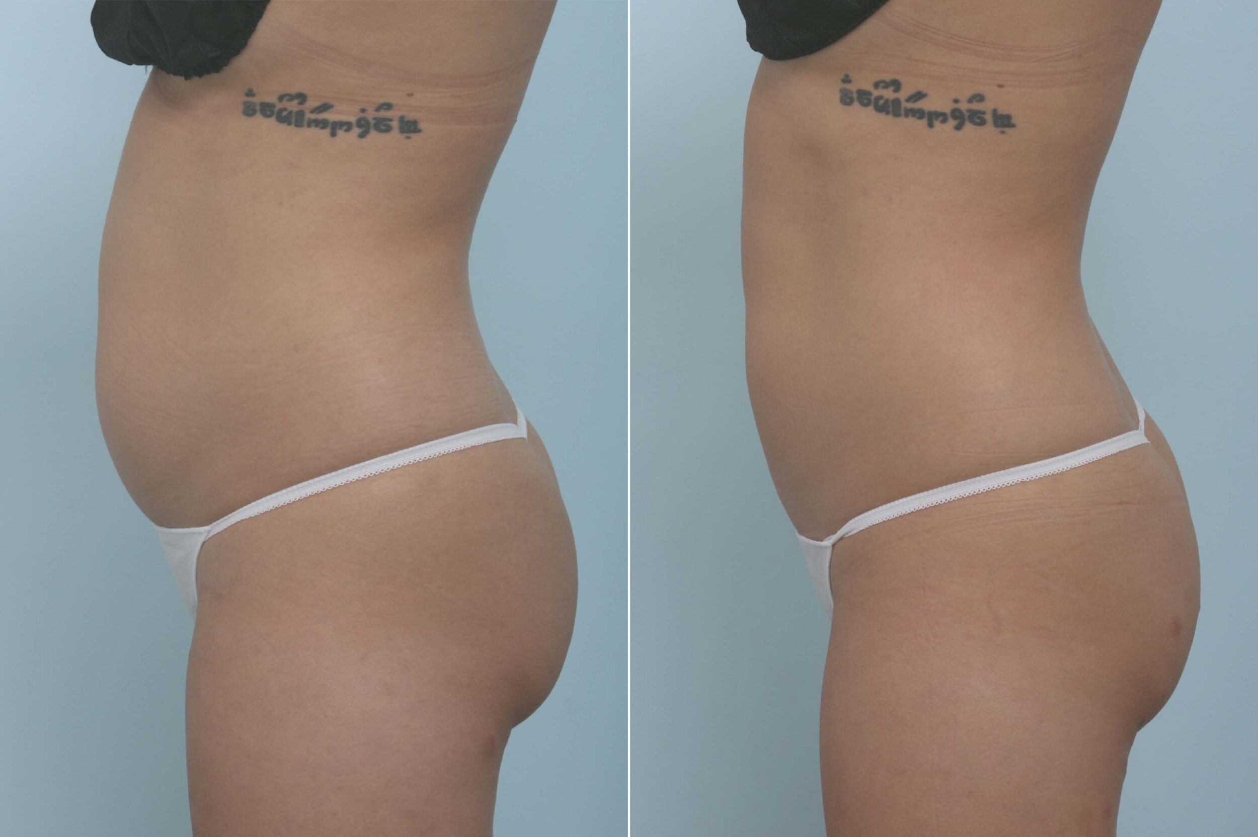 Before and After Image: CoolSculpting Before and After Photos in Houston, TX, Patient 11717 - left-side