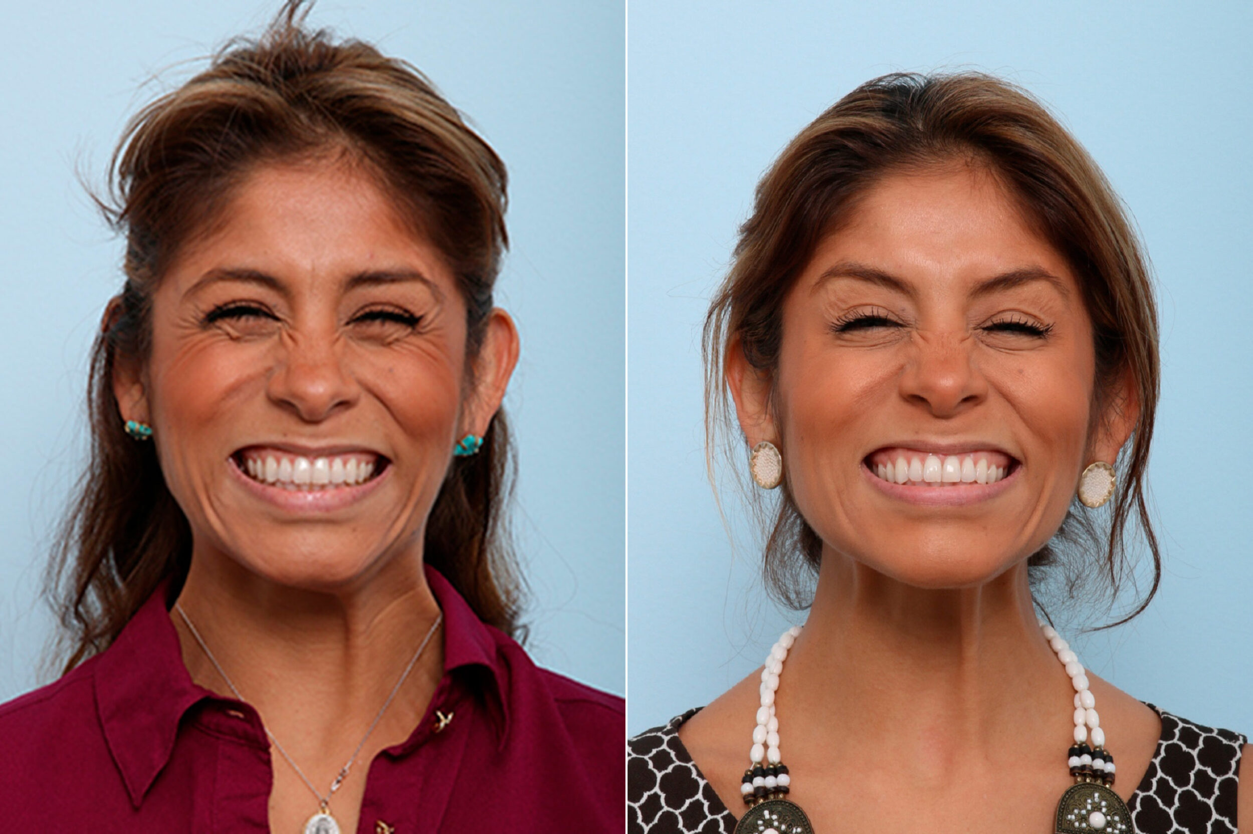 Before and After Image: Botox® Cosmetic & Xeomin Before and After Photos in Houston, TX, Patient 7738 - front