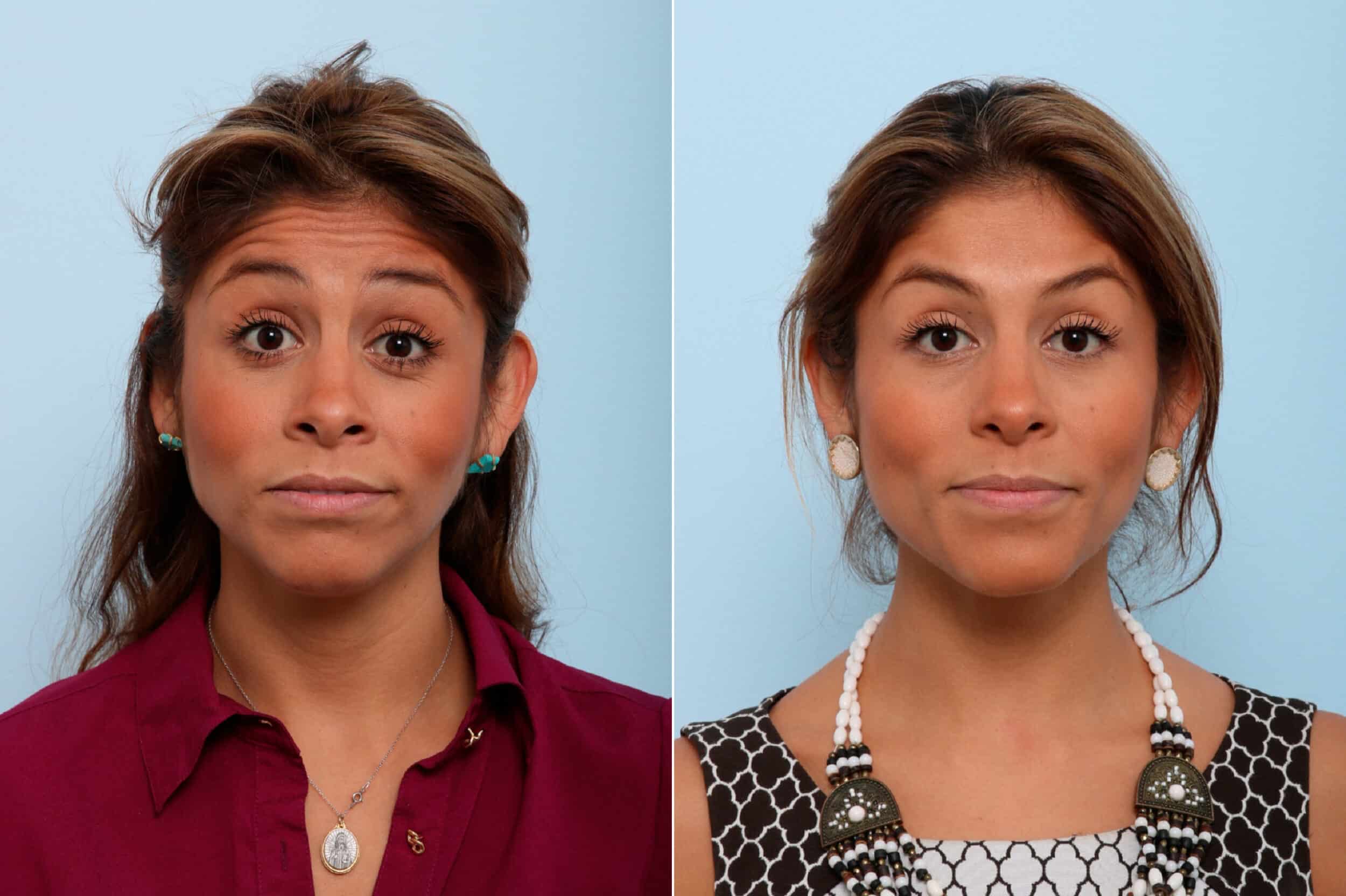 Before and After Image: Botox® Cosmetic & Xeomin Before and After Photos in Houston, TX, Patient 7738 - front