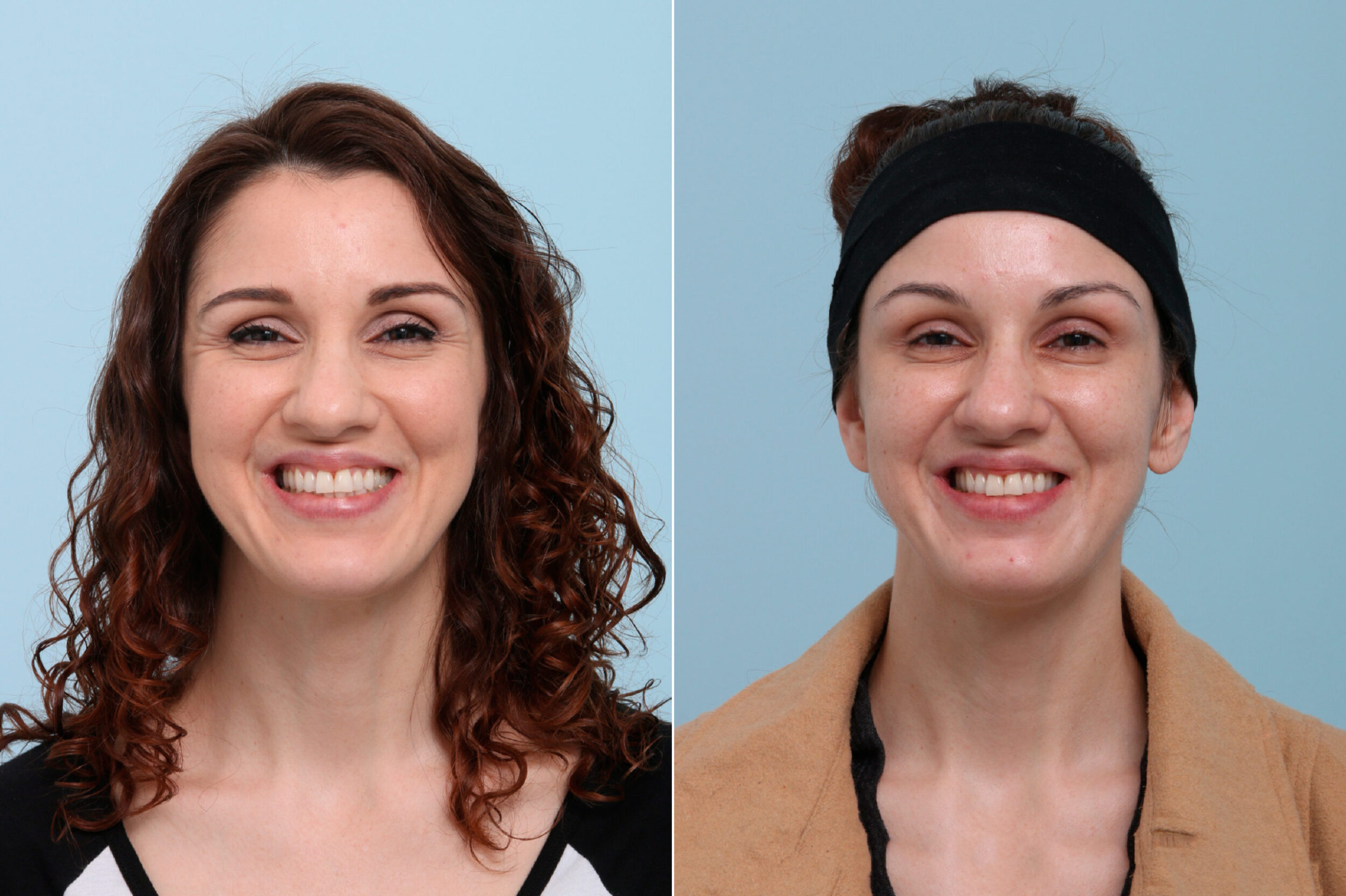 Before and After Image: Botox® Cosmetic & Xeomin Before and After Photos in Houston, TX, Patient 7745 - front