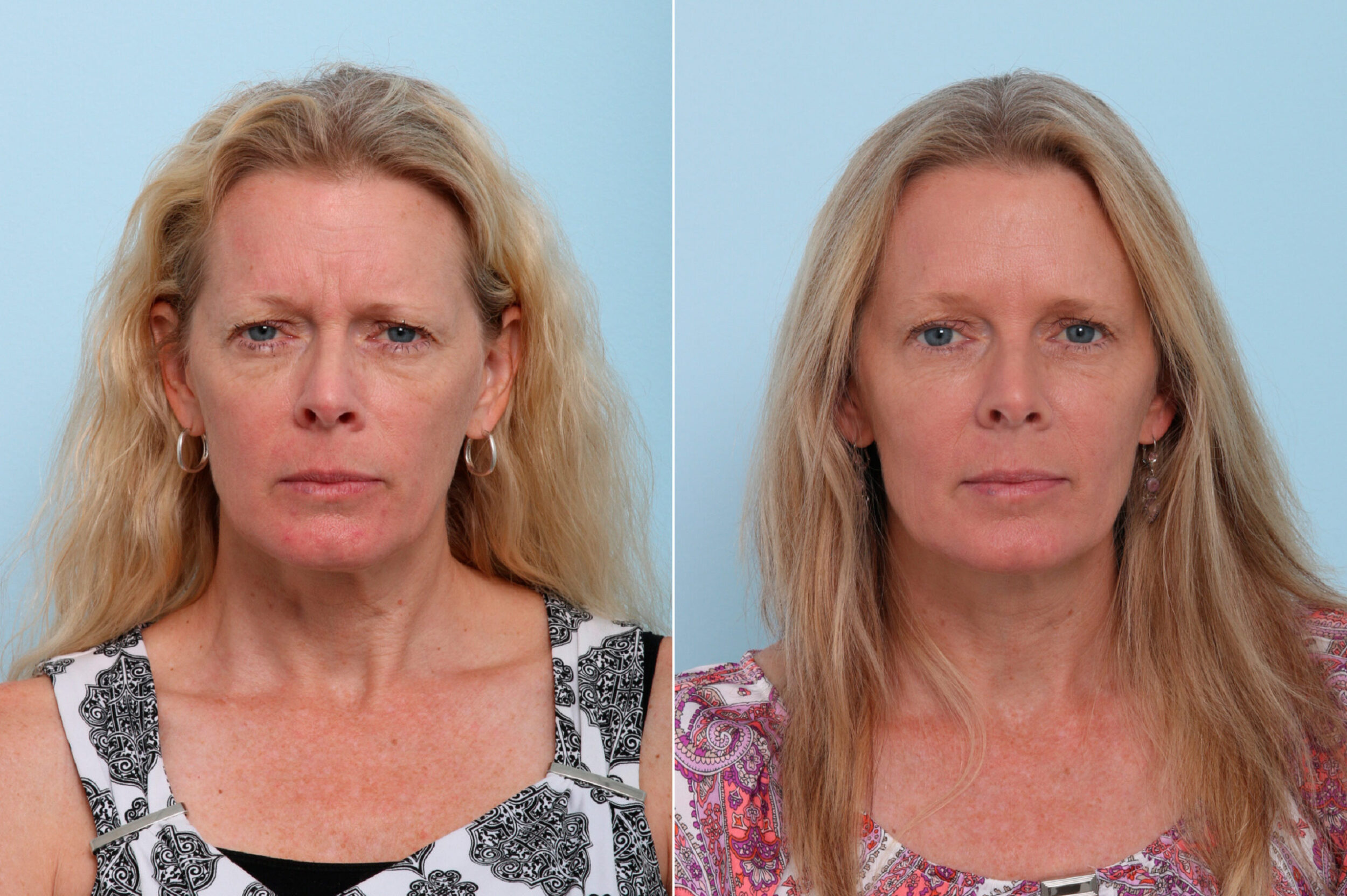 Before and After Image: Botox® Cosmetic & Xeomin Before and After Photos in Houston, TX, Patient 7750 - front