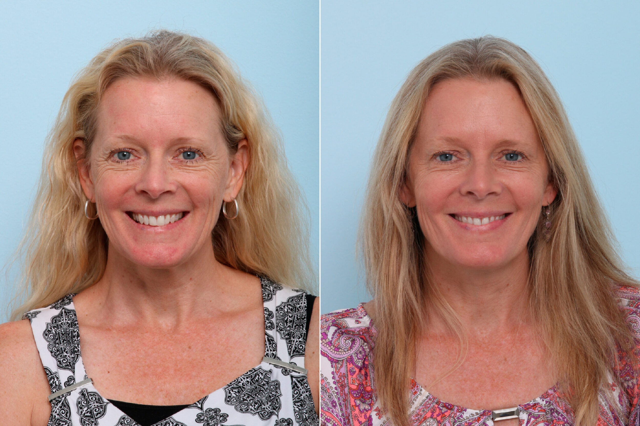 Before and After Image: Botox® Cosmetic & Xeomin Before and After Photos in Houston, TX, Patient 7750 - front