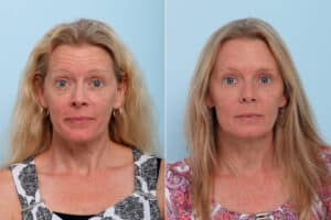 patient 7750 botox cosmetic before after scaled