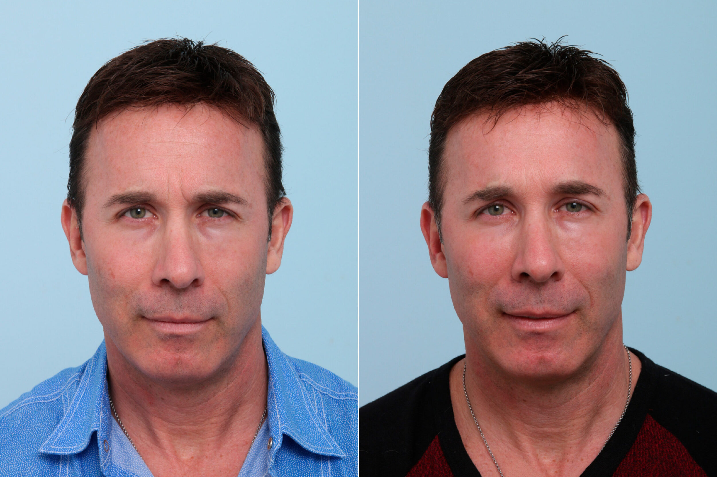 Before and After Image: Botox® Cosmetic & Xeomin Before and After Photos in Houston, TX, Patient 7757 - front