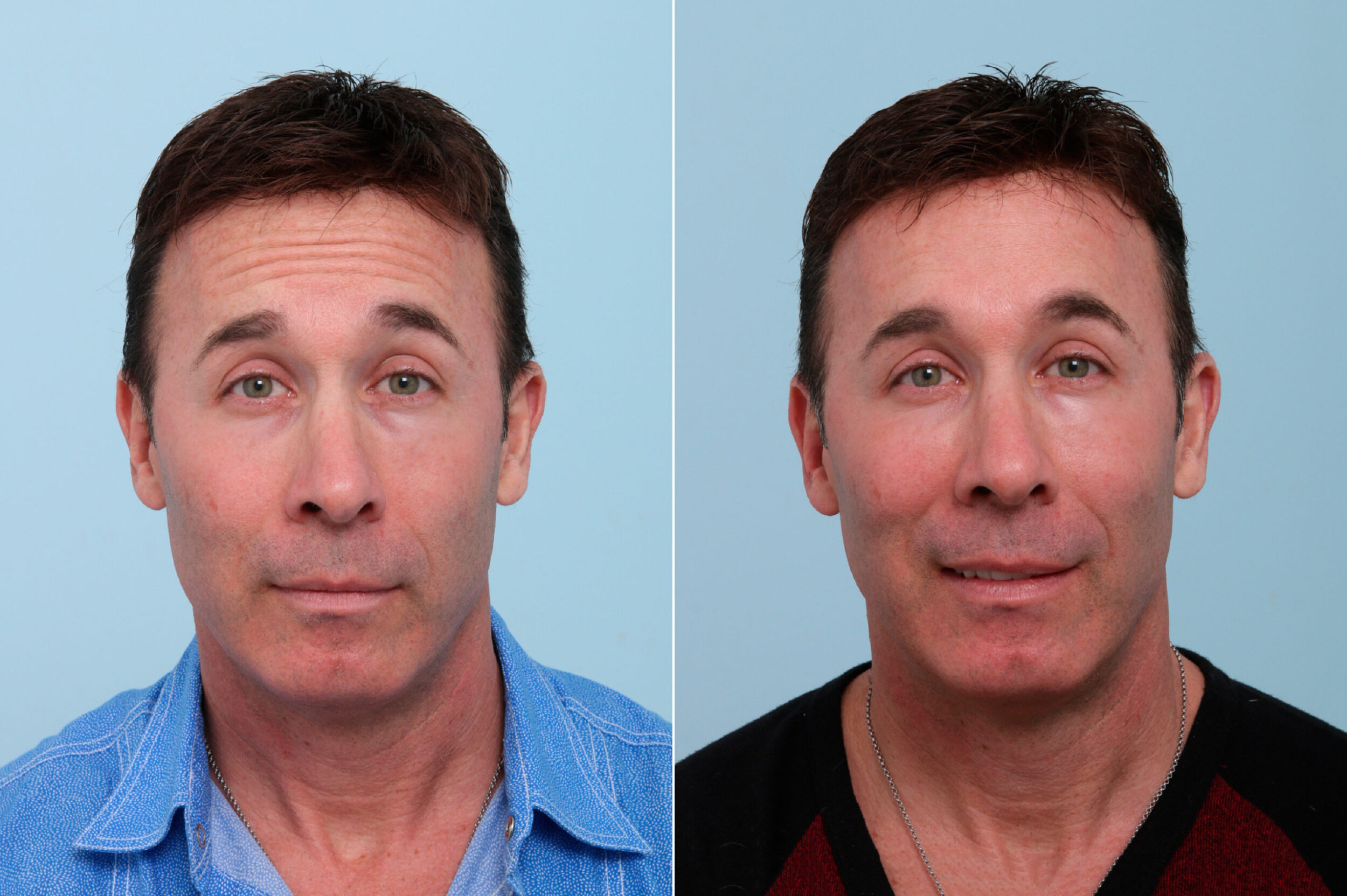 Before and After Image: Botox® Cosmetic & Xeomin Before and After Photos in Houston, TX, Patient 7757 - front