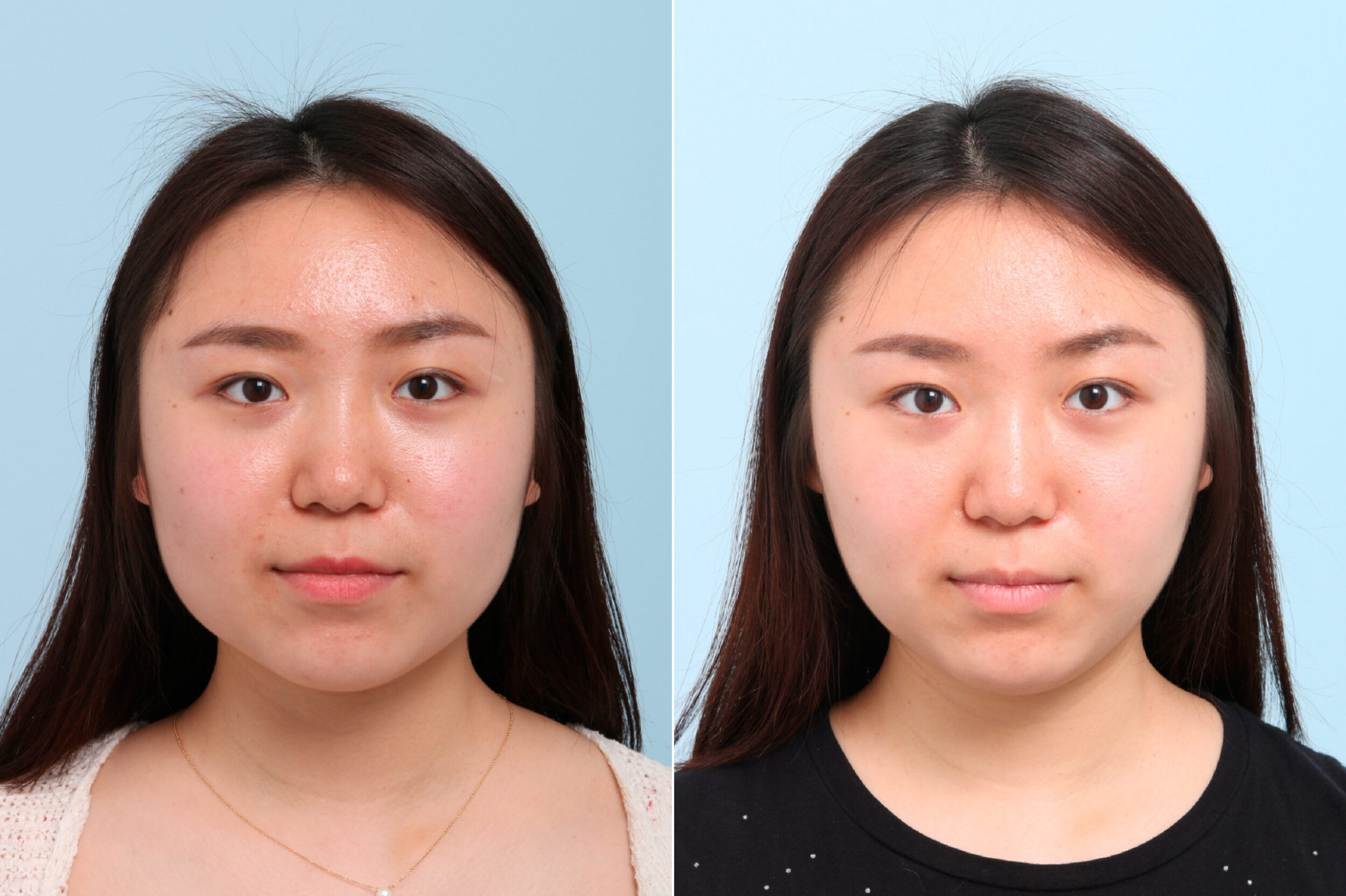 Before and After Image: Botox® Cosmetic & Xeomin Before and After Photos in Houston, TX, Patient 7764 - front