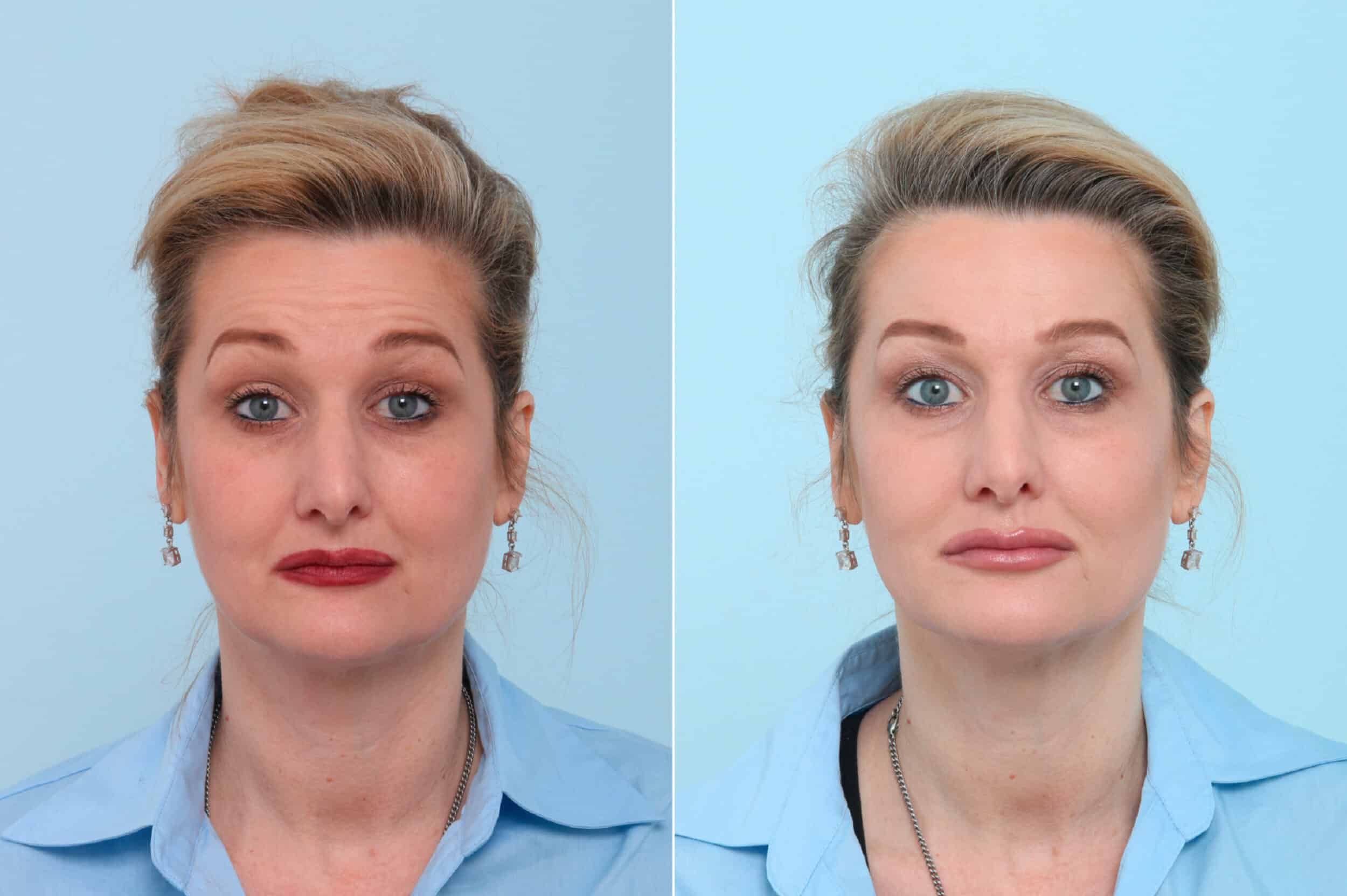 Before and After Image: Botox® Cosmetic & Xeomin Before and After Photos in Houston, TX, Patient 7770 - front