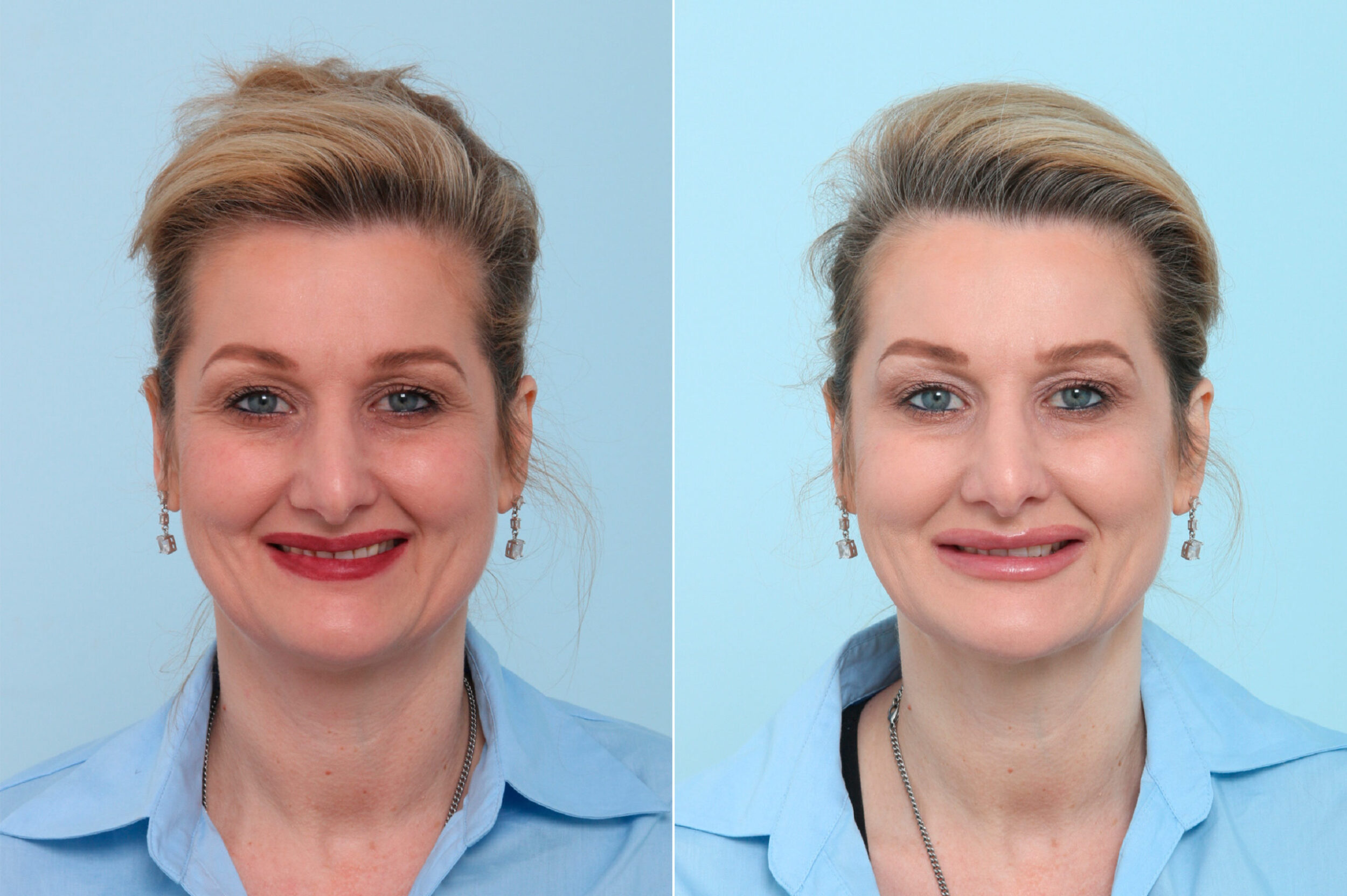 Before and After Image: Botox® Cosmetic & Xeomin Before and After Photos in Houston, TX, Patient 7770 - front