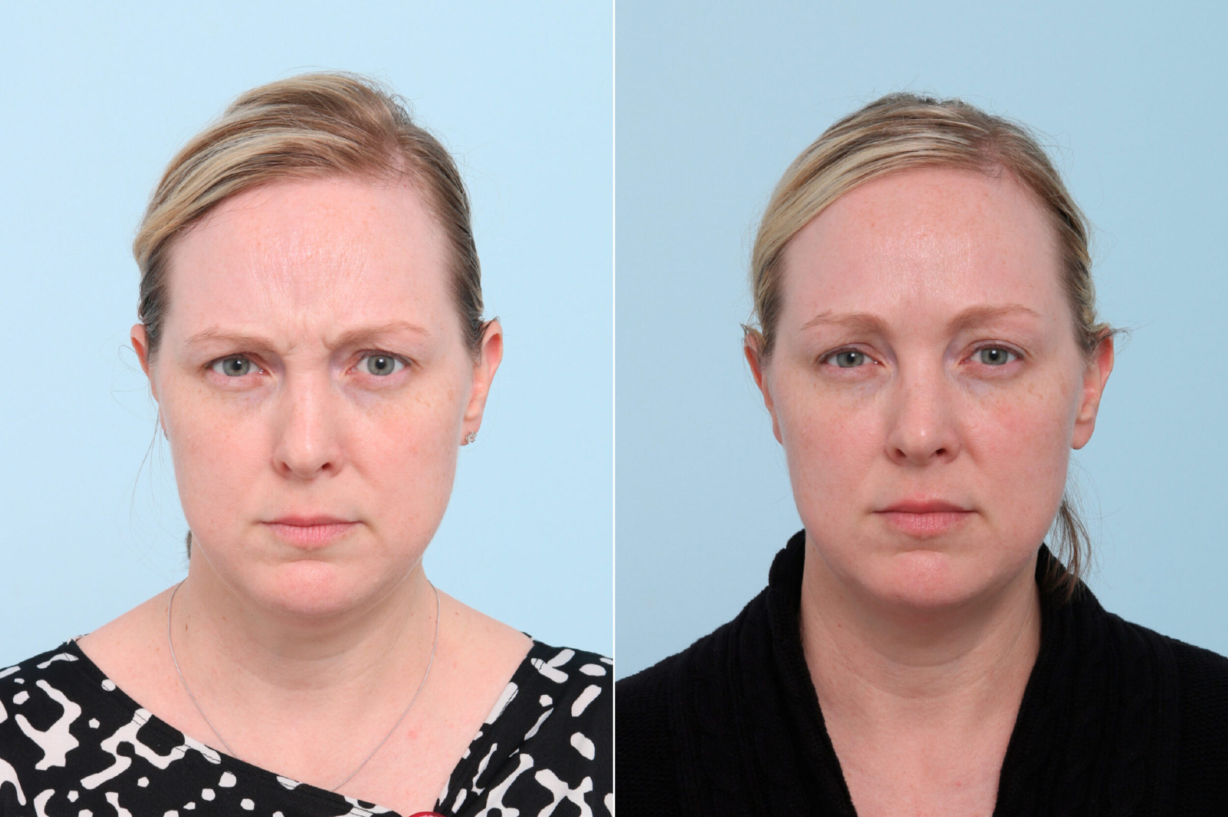 Before and After Image: Botox® Cosmetic & Xeomin Before and After Photos in Houston, TX, Patient 7775 - front