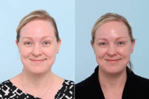 patient 7775 botox cosmetic before after scaled