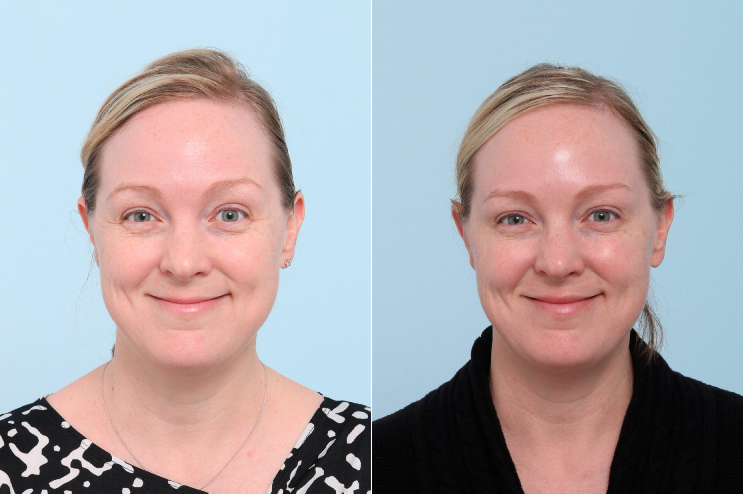 Before and After Image: Botox® Cosmetic & Xeomin Before and After Photos in Houston, TX, Patient 7775 - front