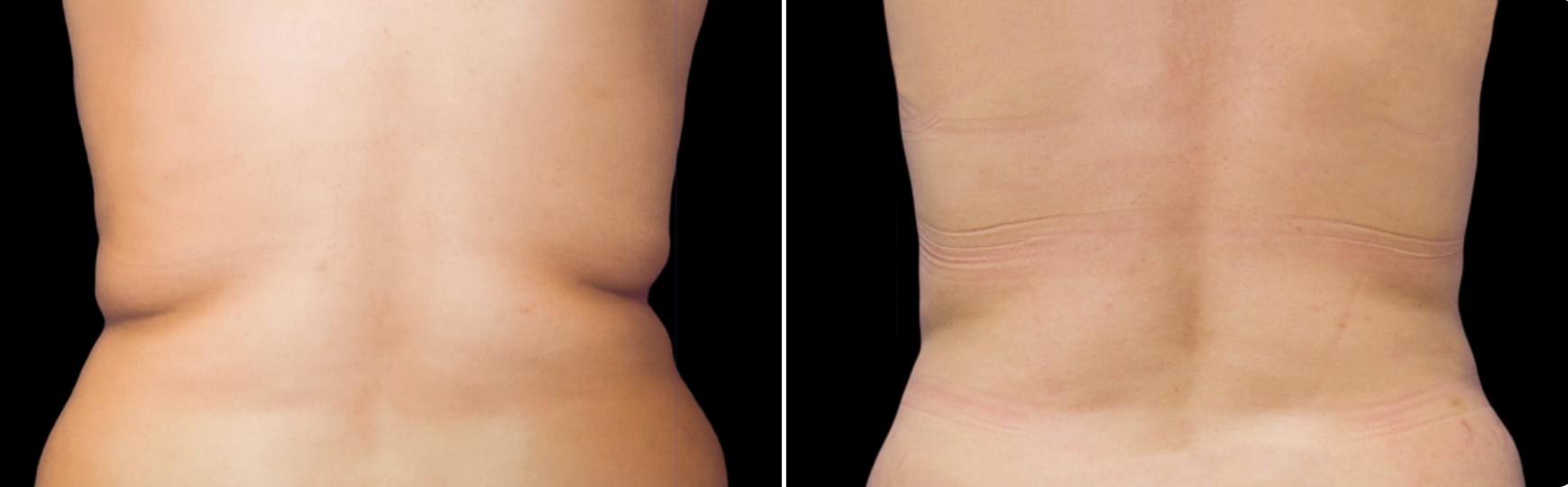 Before and After Image: CoolSculpting Before and After Photos in Houston, TX, Patient 7803 - back