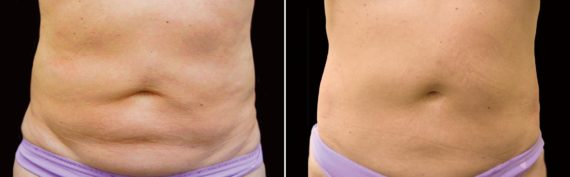 patient 7780 coolsculpting before after 4 570x177
