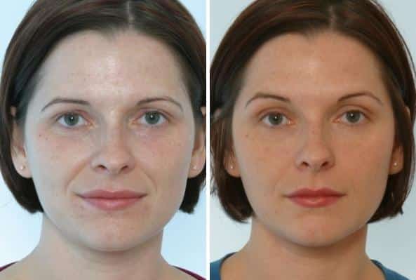 Before and After Image: Fillers Before and After Photos in Houston, TX, Patient 7883 - front