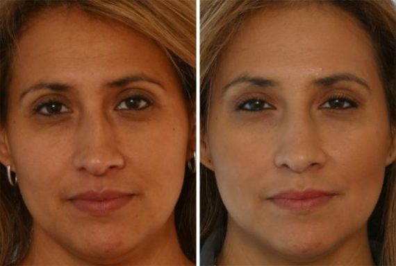 patient 7880 fillers before after 6 570x384