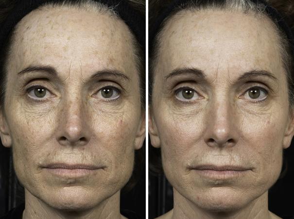 Before and After Image: Fraxel Laser Before and After Photos in Houston, TX, Patient 7953 - front