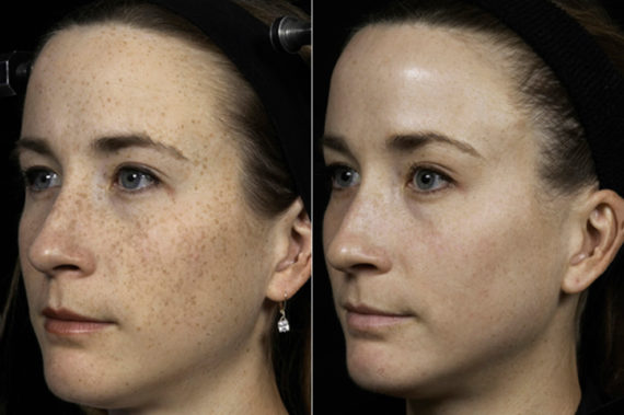 patient 7944 fraxel laser before after 570x379