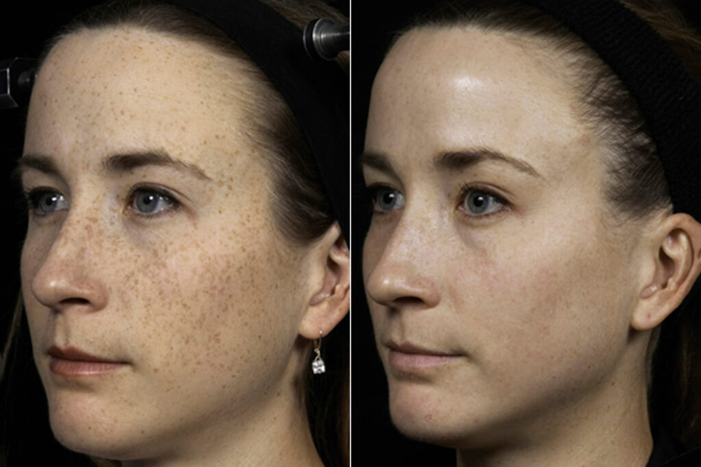 patient 7944 fraxel laser before after scaled