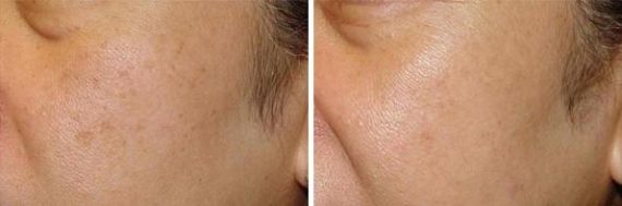 patient 7980 ipl before after 2 570x189