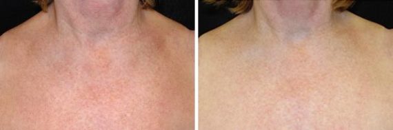 patient 7980 ipl before after 3 570x189