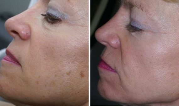 patient 7980 ipl before after 570x340