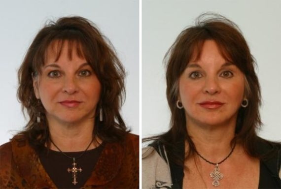 patient 7995 juvederm injectable gel before after 1 570x384