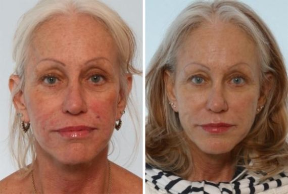 patient 7995 juvederm injectable gel before after 6 570x384