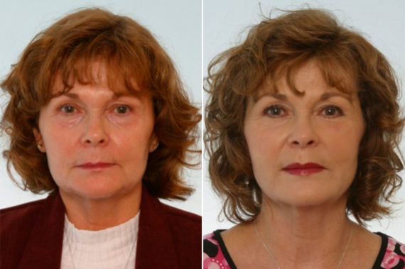 patient 8006 juvederm injectable gel before after 570x379