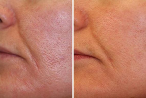 patient 8016 laser genesis before after 1 570x384