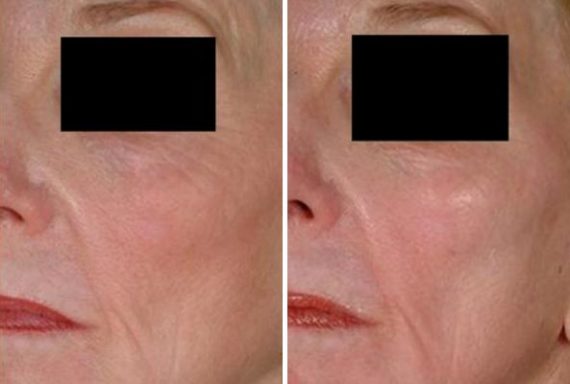 patient 8016 laser genesis before after 2 570x384