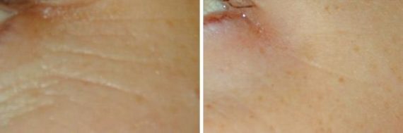 patient 8016 laser genesis before after 6 570x189