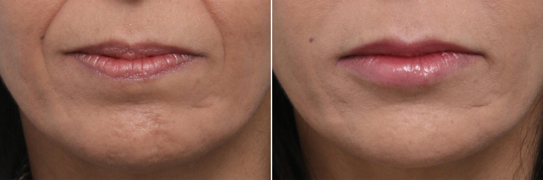 Before and After Image: Lip Enhancement Before and After Photos in Houston, TX, Patient 8062 - front