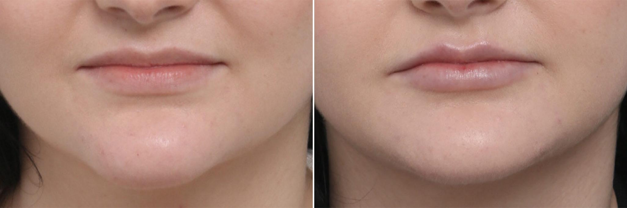 Before and After Image: Lip Enhancement Before and After Photos in Houston, TX, Patient 8072 - front