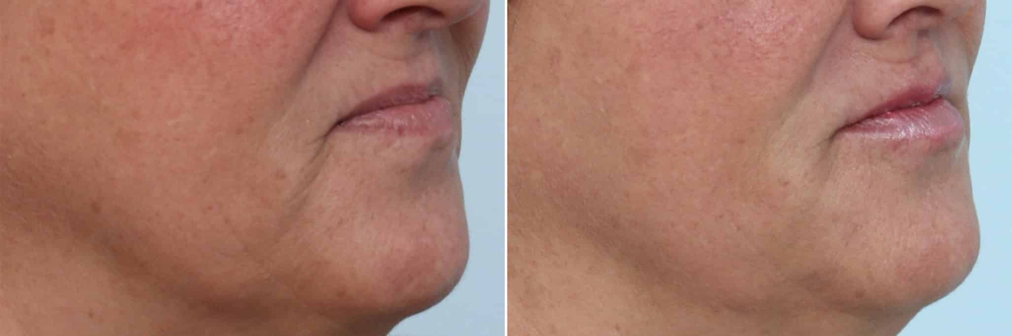 Before and After Image: Lip Enhancement Before and After Photos in Houston, TX, Patient 8077 - right-front-oblique