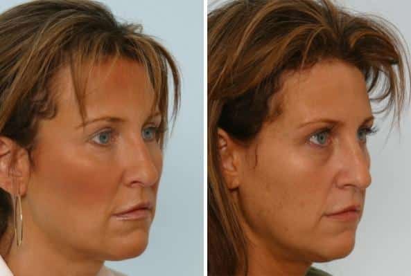 Before and After Image: Fillers Before and After Photos in Houston, TX, Patient 8105 - right-front-oblique