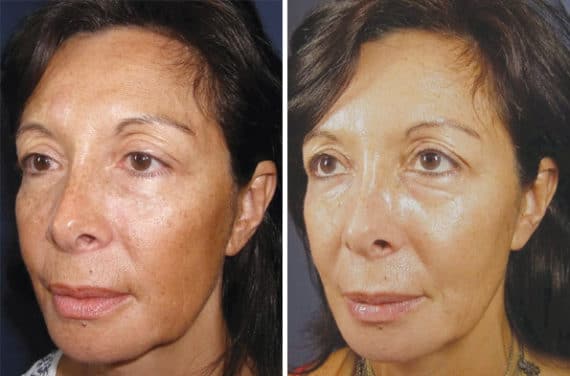 patient 8348 chemical peels before after 570x376 (1)