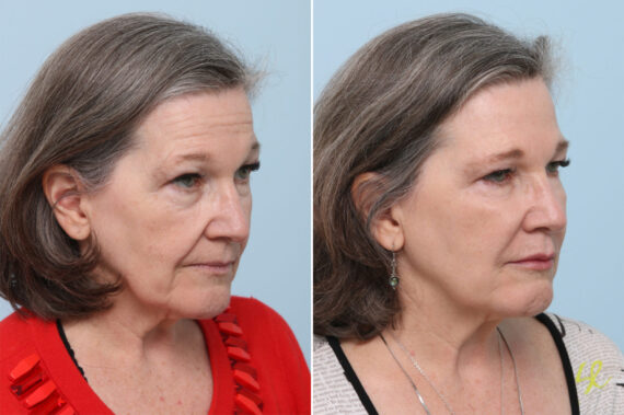 patient 8365 fillers before after 1 570x379