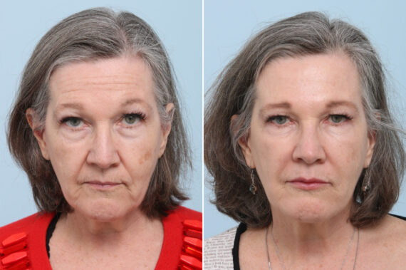 patient 8365 fillers before after 570x379
