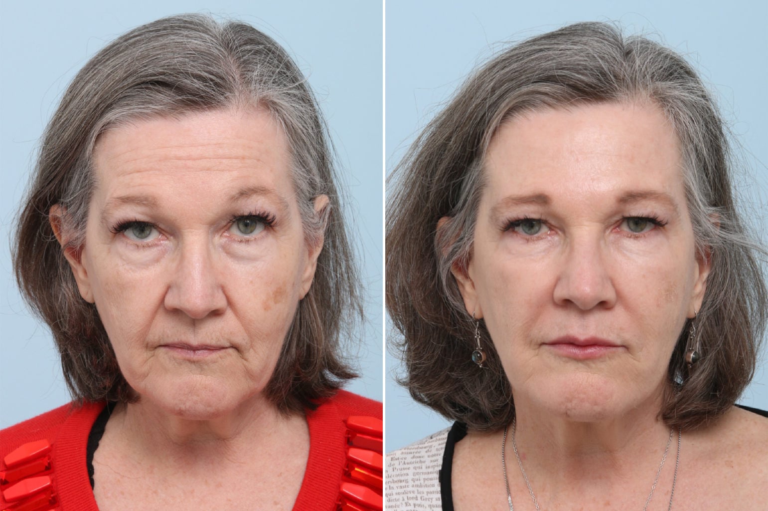 Before and After Image: Fillers Before and After Photos in Houston, TX, Patient 8365 - front