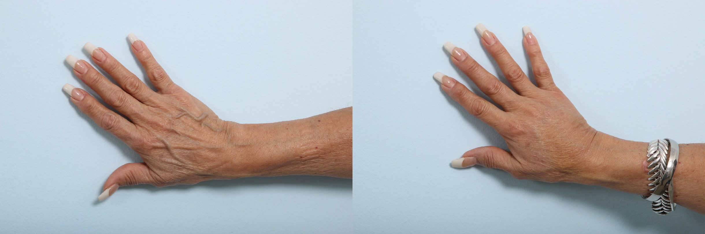 Before and After Image: Fillers Before and After Photos in Houston, TX, Patient 17468 - front