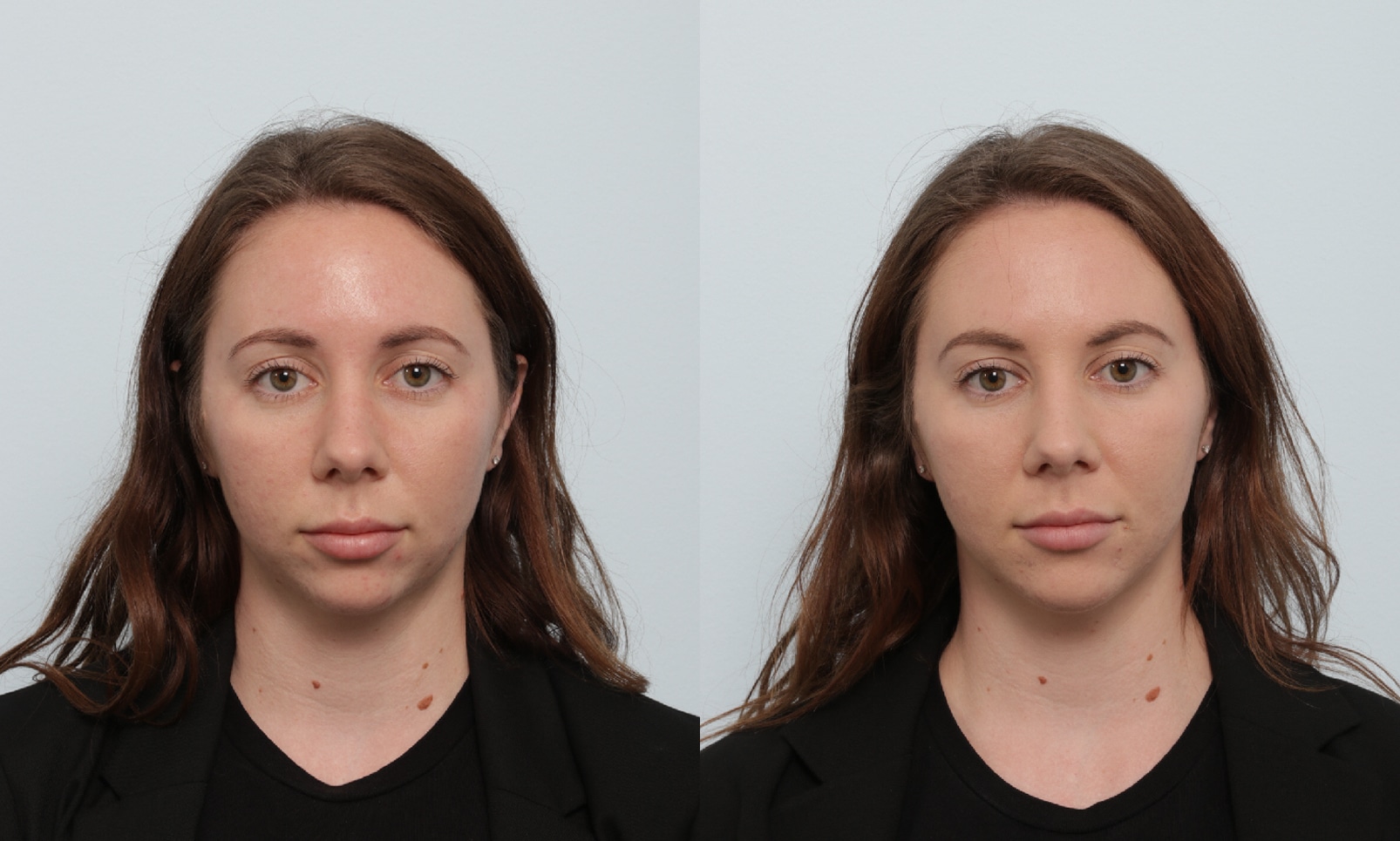 Before and After Image: Fillers Before and After Photos in Houston, TX, Patient 17515 - front