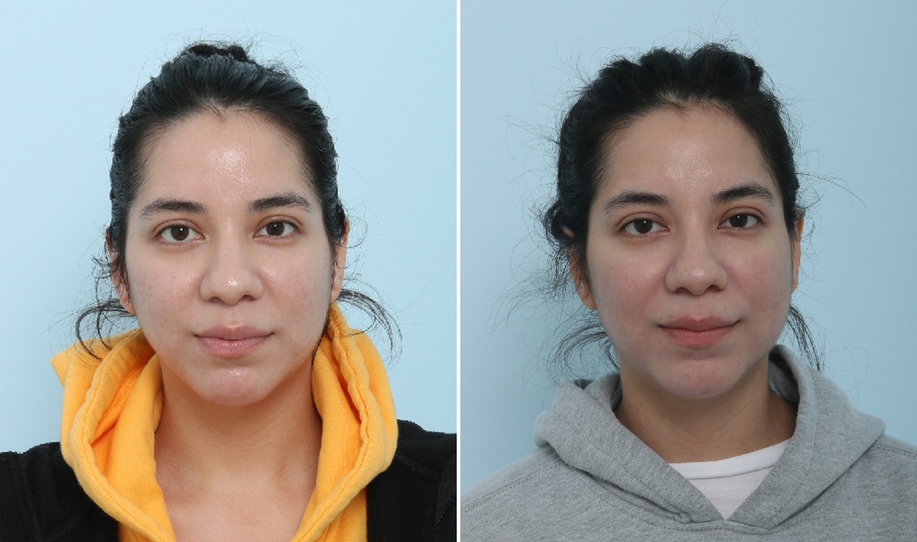 Before and After Image: Fraxel Laser Before and After Photos in Houston, TX, Patient 17570
