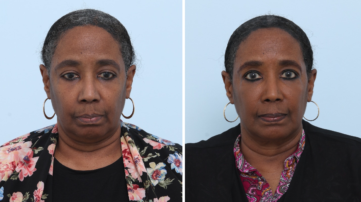 Before and After Image: Ulthera Lift Before and After Photos in Houston, TX, Patient 17575 - front