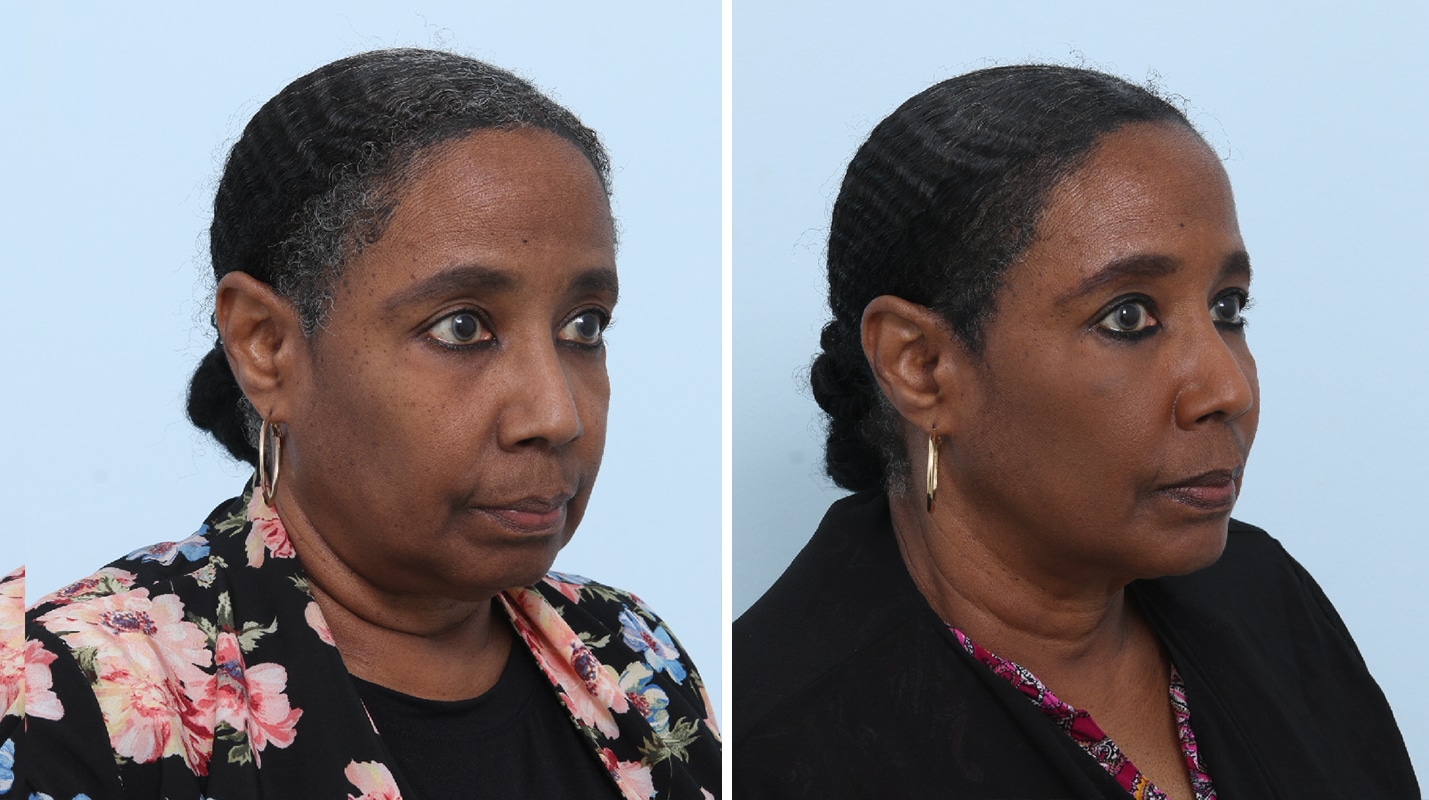 Before and After Image: Ulthera Lift Before and After Photos in Houston, TX, Patient 17575 - right-front-oblique