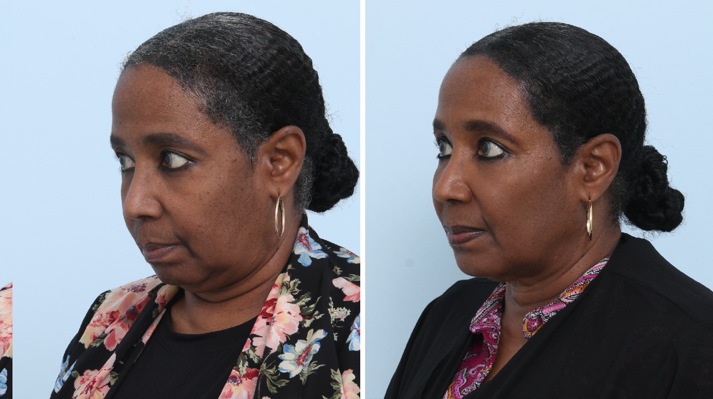 Before and After Image: Ulthera Lift Before and After Photos in Houston, TX, Patient 17575 - left-front-oblique