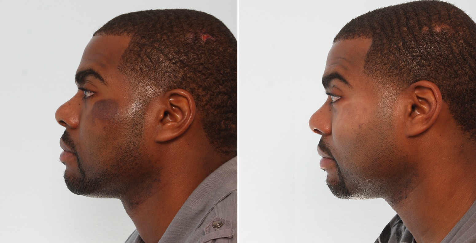 Before and After Image: Laser Genesis Before and After Photos in Houston, TX, Patient 17580 - left-side